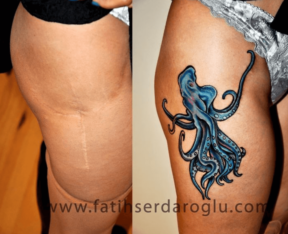 Is Tattooing Your Legs a Solution to Cover Up Varicose Veins