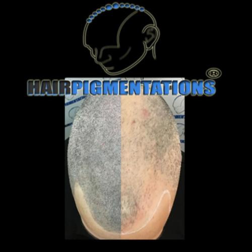 038_fatihserdaroglucom_saçpigmentasyonu Scalp Micro Pigmentation 5