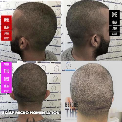 043_fatihserdaroglucom_Scalp Micro Pigmentation Hairpigmentation 142
