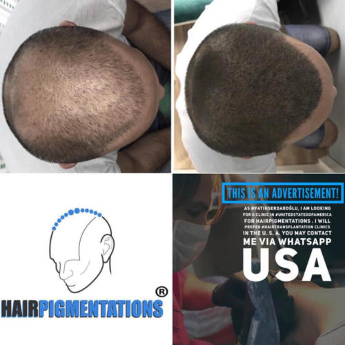 075_fatihserdaroglucom_Scalp Micro Pigmentation Hairpigmentation 267